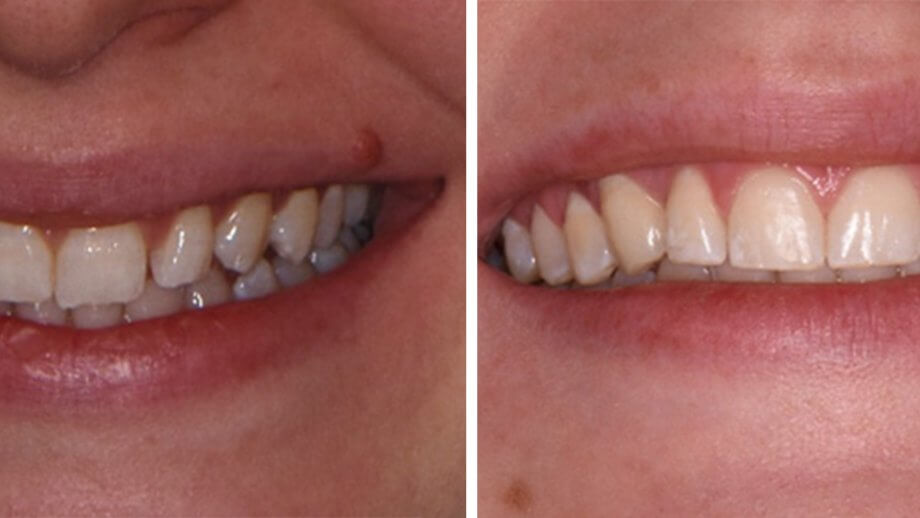 Minimally Invasive Esthetics to a Stellar Smile