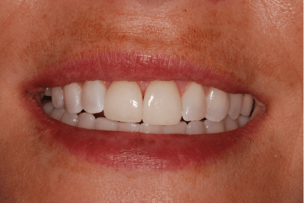 Front Teeth Veneers Prior