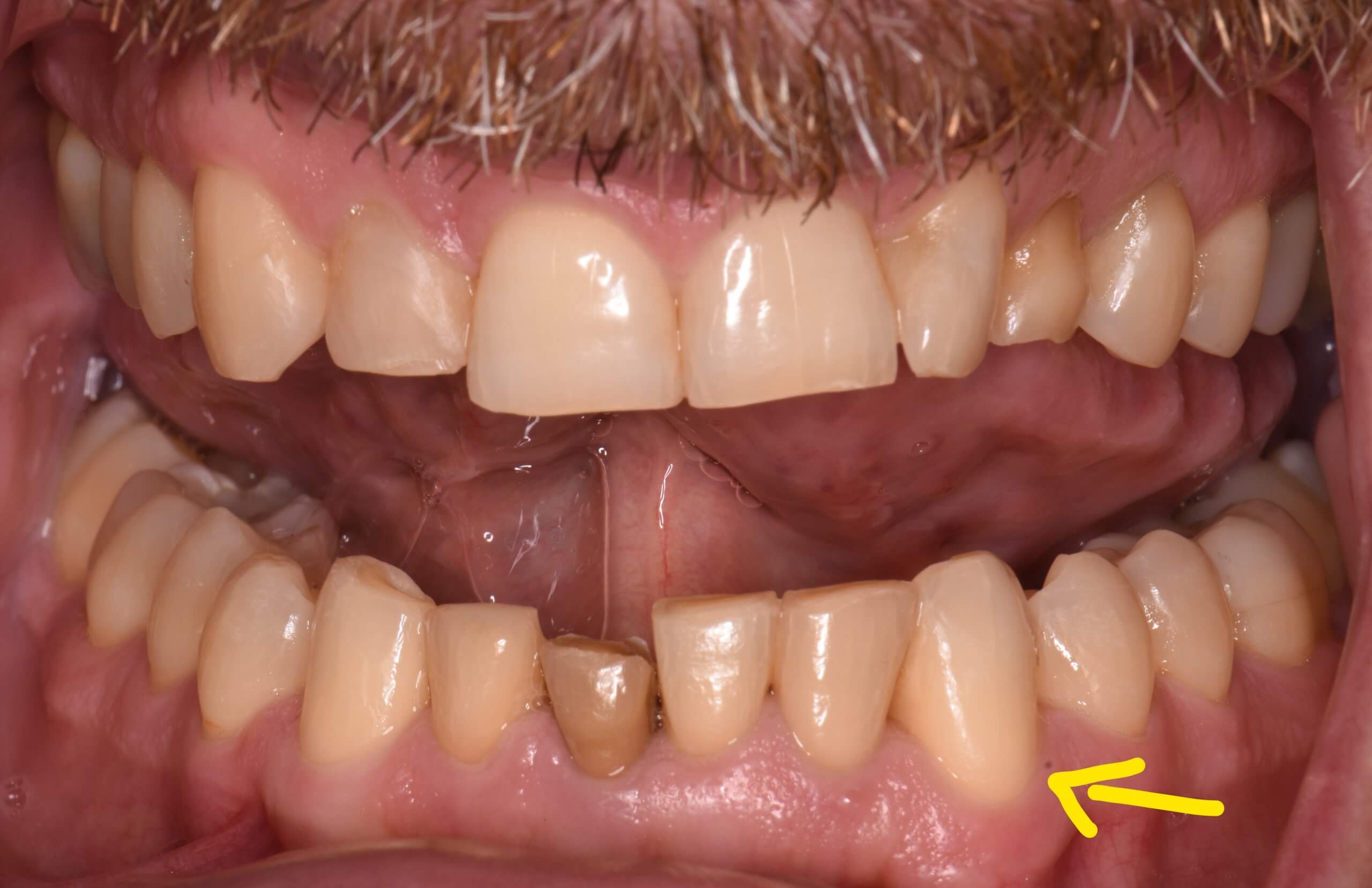 Improved positioning of lower left canine