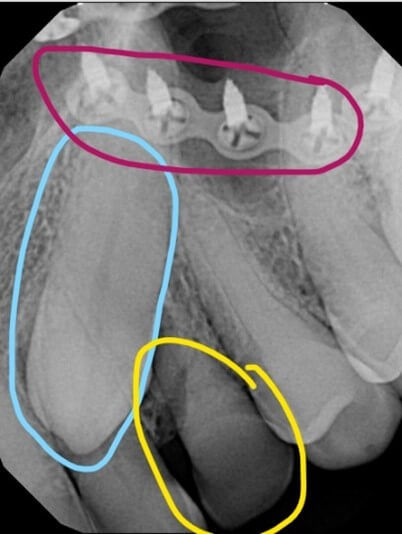 X-ray illustrating the patient’s baseline conditions