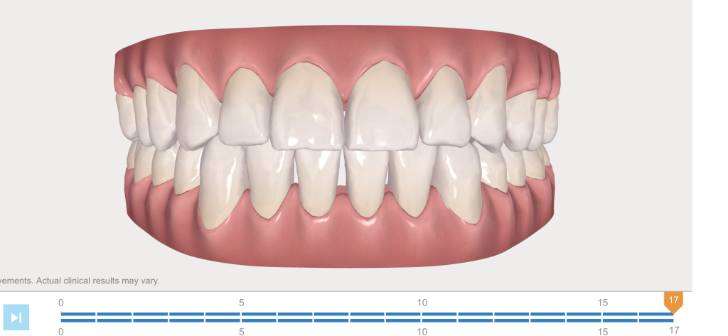 Invisalign Case Study Dental Health Concepts Invisalign Case Study Dental Health Concepts
