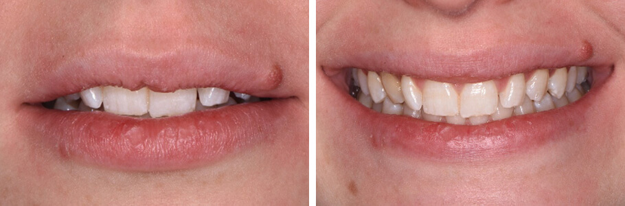 Invisalign, Re-shaping, and Bleaching as an Alternative to Porcelain Veneers