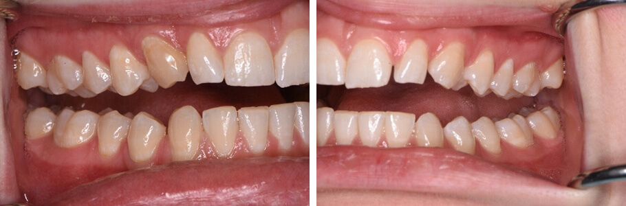 Invisalign, Re-shaping, and Bleaching as an Alternative to Porcelain Veneers