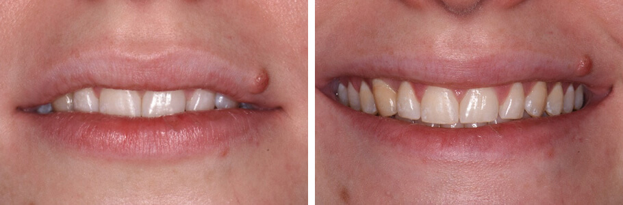 Invisalign, Re-shaping, and Bleaching as an Alternative to Porcelain Veneers