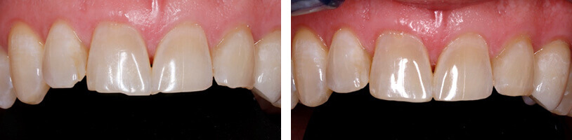 Invisalign, Re-shaping, and Bleaching as an Alternative to Porcelain Veneers