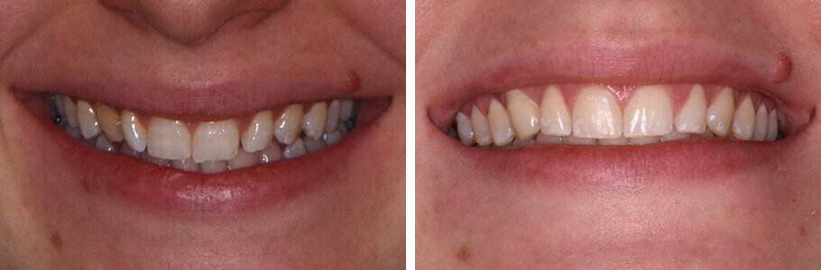 Invisalign, Re-shaping, and Bleaching as an Alternative to Porcelain Veneers